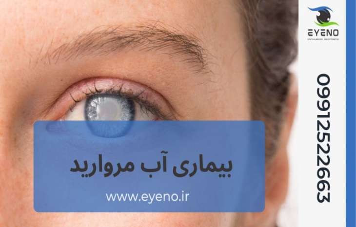 بیماری آب مروارید چیست + انواع بیماری Cataracts